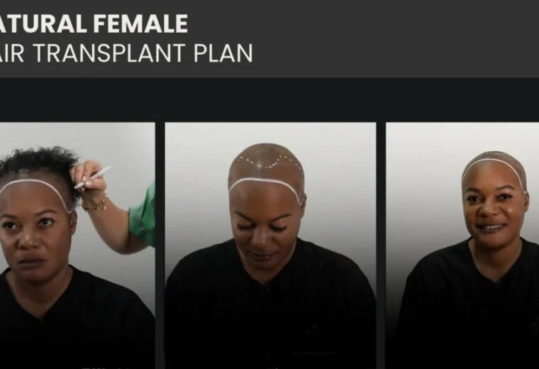 can birth control cause hair loss