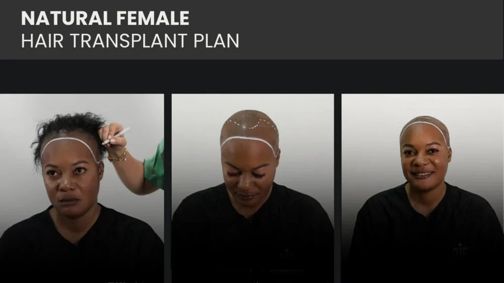 can birth control cause hair loss